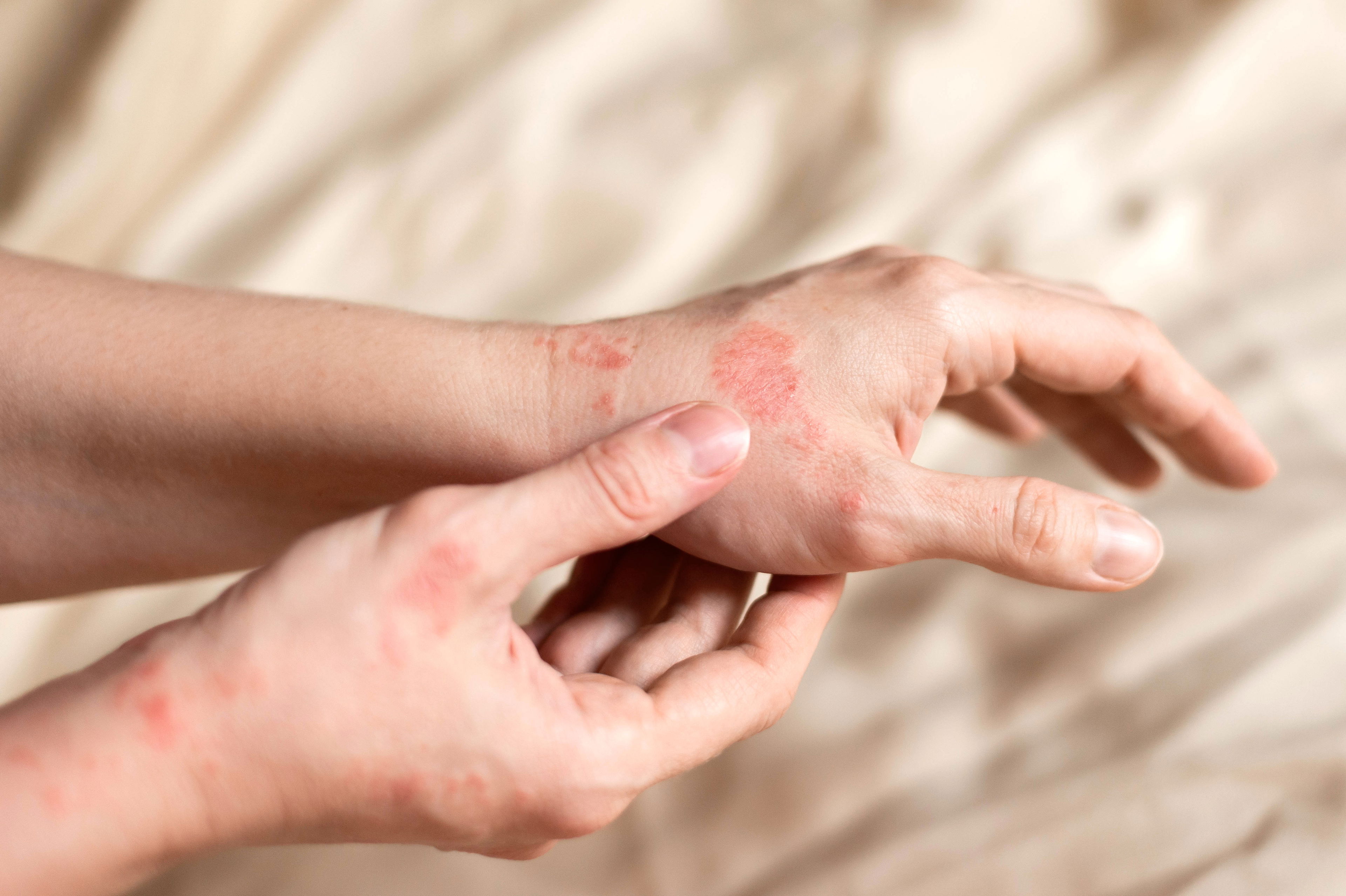 CBD bei Schuppenflechte – natürliche Hilfe bei entzündlicher Haut Hand mit roten, schuppigen Hautstellen bei Schuppenflechte – CBD als mögliche Unterstützung bei Hauterkrankungen
